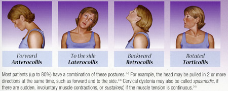 cervical dystonia botox